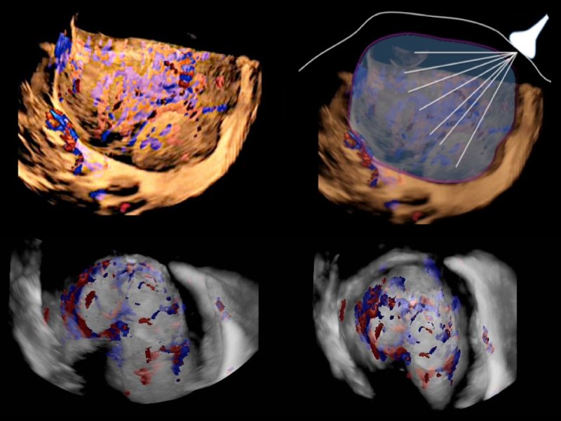 Виртуальная цистоскопия - на границе между серозной оболочкой и мочевым пузырем выявляется обширная васкуляризация на фоне интактной слизистой мочевого пузыря (прорастание на ранней стадии)