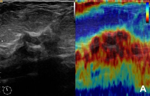 УЗИ молочной железы - карцинома при сильной компрессии (слева B-режим, справа эластограмма)