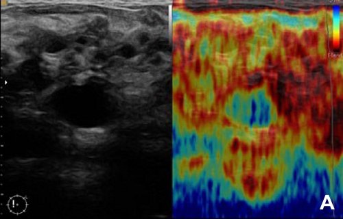 УЗИ молочной железы - глубоко расположенная киста при умеренной компрессии (слева B-режим, справа эластограмма)