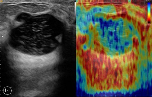 УЗИ молочной железы - крупная геморрагическая киста (слева B-режим, справа эластограмма)
