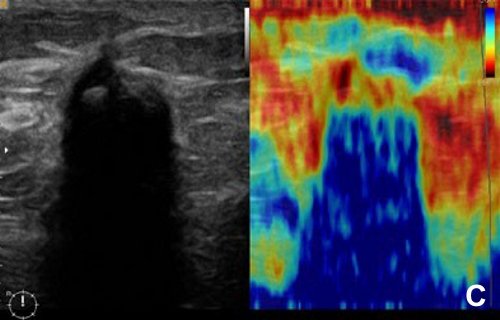 УЗИ молочной железы - грубокальцинированная фиброаденома с полным исчезновением сигнала позади опухоли (слева B-режим, справа эластограмма)