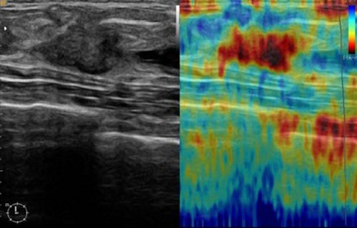 УЗИ молочной железы - карцинома и протоковая структура (слева B-режим, справа эластограмма)