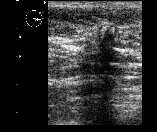 Инвазивный протоковый рак - гипоэхогенное вертикально ориентированное образование неправильной формы с нечеткими неровными контурами и дистальным звукоослаблением