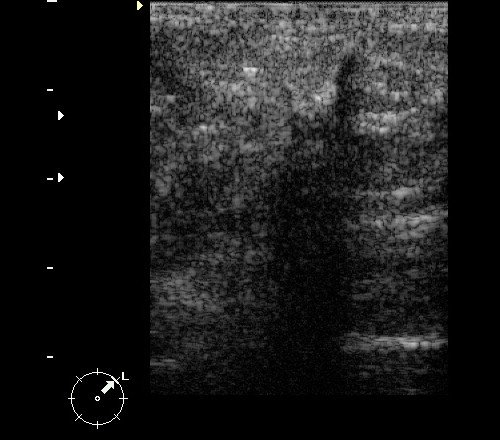 Инвазивный протоковый рак - гипоэхогенное вертикально ориентированное образование неправильной формы с нечеткими лучистыми контурами и дистальным звукоослаблением
