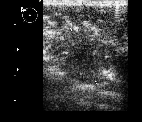 Инвазивный протоковый рак - гипоэхогенное вертикально ориентированное образование неправильно-овальной формы с размытыми неровными контурами