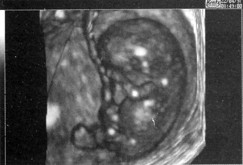Эхограмма - эмбрион