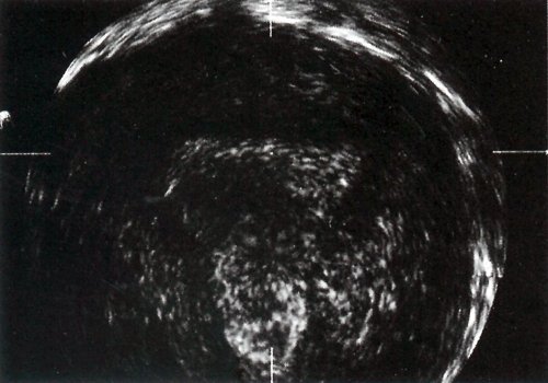 Выпуклая форма дна матки и прямая верхняя граница маточной полости на ультразвуковом срезе нормальной матки