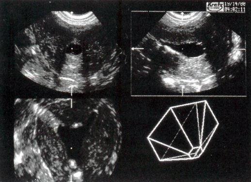 Обычная трансвагинальная эхограмма (а) обнаруживает два отдельных внутриматочных эхосигнала, что позволяет предположить наличие двурогой матки или матки с перегородкой.