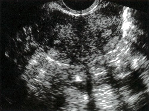 Венечный срез (слева внизу), полученный с помощью трехмерной ультрасонографии (б), выявляет только минимальную выпуклость верхней части полости матки, что свидетельствует о дугообразной матке, клинически незначительной небольшой аномалии