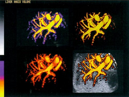 Сосуды печени в режиме цветного картирования