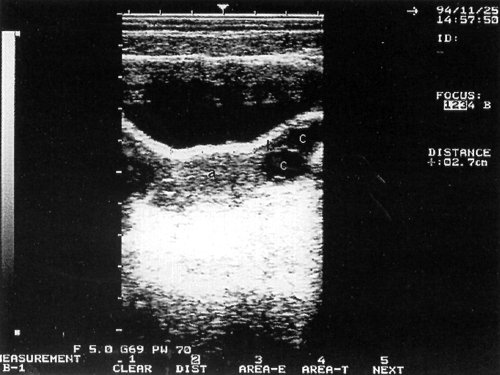 Трансабдоминальное поперечное сканирование матки: а - М-эхо, b - левый яичник, с - фолликулы