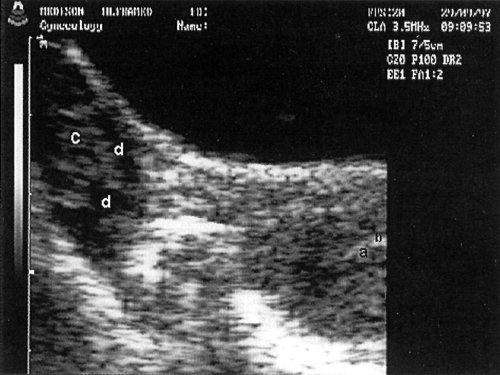 Трансабдоминальное сканирование: а - М-эхо, b - участок очаговой гиперплазии, с - правый яичник, d - фолликулы