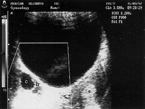 Трансабдоминальное сканирование: а - М-эхо (гиперплазия эндометрия), b - правый яичник, с - фолликул