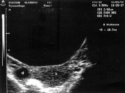 Трансабдоминальное сканирование: а - матка (поперечное сканирование), b - расширенная полость матки, заполненная анэхогенным содержимым, с - правый яичник, d - фолликул