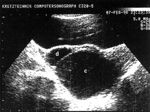 Трансабдоминальное сканирование: а - матка (поперечное сканирование), b - правый яичник, с - фолликулярная киста, d - фолликул