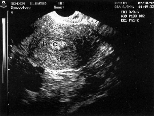 Трансвагинальное сканирование: а - матка (поперечное сканирование), b - эндометрий, с - полип полости матки