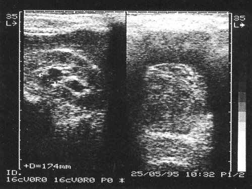 Тампонада сгустком крови мочевого пузыря (справа) и расширение чашечно-лоханочной системы почки (слева), окончательный диагноз - геморрагический цистит