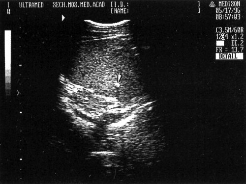 Эхографическая картина мелког кальцината печени (отмечен стрелкой)