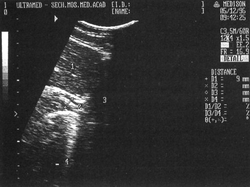 Эхографическая картина неизмененного брюшного отдела пищевода: 1-печень, 2-брюшной отдел пищевода, 3-сердце, 4-диафрагма