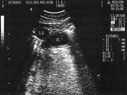 Эхографическая картина гиперсекции желудка, видны 5 слоев стенки: St.-желудок, G.B.-желчный пузырь