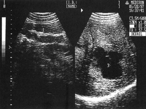 Эхографическая картина одного из вариантов тела желудка и метастатического поражения печени: 1-утолщенная стенка желудка, 2-печень, 3-метастаз