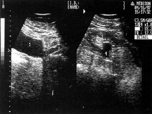 Эхографическая картина почки с дилатацией лоханки и проксимального отдела мочеточника: 1-мочевой пузырь, 2-мочеточник, 3-почка, 4-лоханка