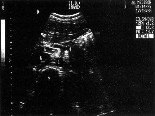 Эхографическая картина поперечного сечения аорты, чревной артерии и ее ветвей: 1-аорта, 2-чревная артерия, 3-печеночная артерия, 4-селезеночная артерия, 5-портальная вена, 6-нижняя полая вена, 7-позвоночник