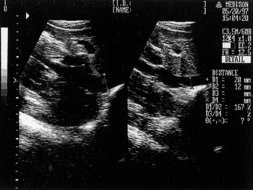 Эхографическая картина нижней полой вены (слева - при свободном дыхании, справа при натуживании)