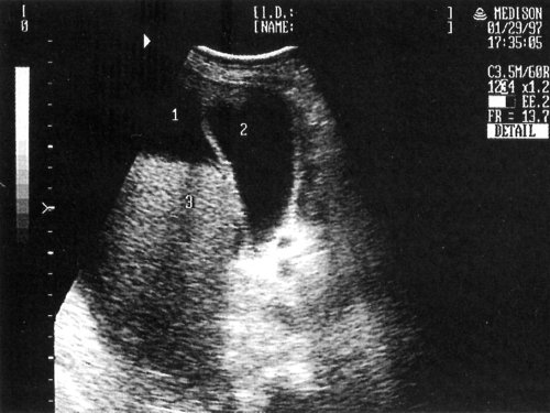 Эхографическая картина одного из вариантов декомпенсированного цирроза печени: 1-асцит, 2-желчный пузырь, 3-печень