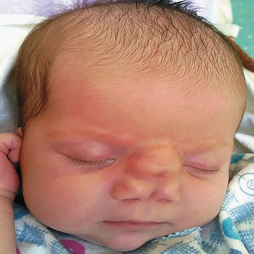 Фото - постнатальный фенотип новорожденного с ФНД (клинический случай 1)