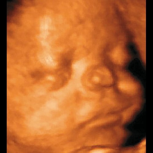 Эхограмма - пренатальный фенотип ФНД в 34 нед беременности (клинический случай 2)