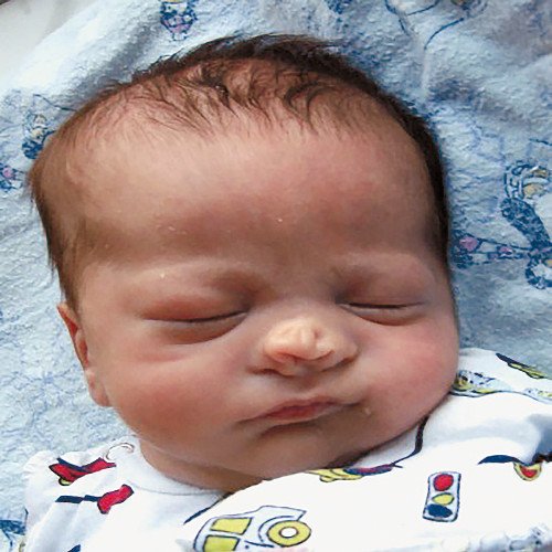 Фото - постнатальный фенотип новорожденного с ФНД (клинический случай 2)