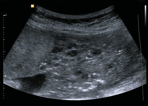Эхограмма - структурные изменения плаценты, частичный пузырный занос, 15 недель беременности