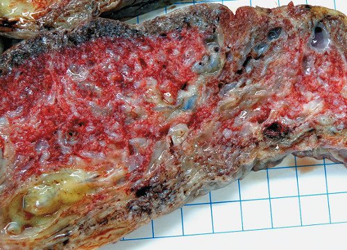 МДП - макроскопическая картина, крупные извитые сосуды, окруженные желеобразным материалом, кистозные полости, обилие фибриноида