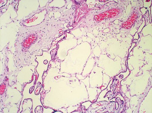 Мезенхимальная дисплазия плаценты - микроскопическая картина (х200), резкий отек стволовых ворсин с образованием полостей, окраска гематоксилином и эозином