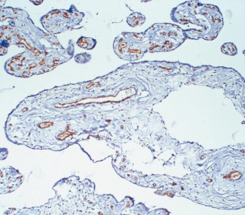 МДП - микроскопическая картина (х100), отечная стволовая ворсина с формированием полостей, в сохранной строме видны многочисленные сосуды разного диаметра, иммуногистохимическая реакция с антителами к CD31