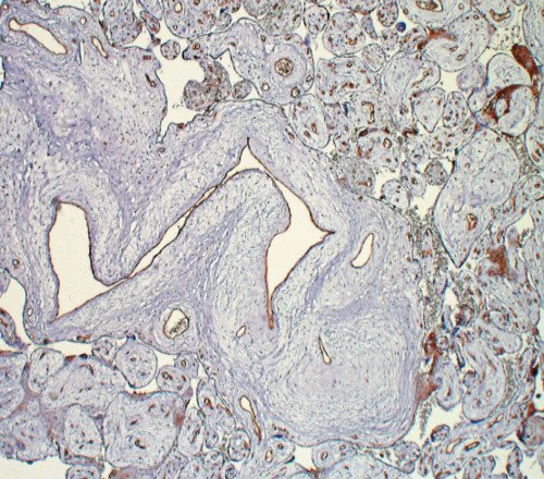 МДП - микроскопическая картина (х200), извитой, расширенный сосуд стволовой ворсины, иммуногистохимическая реакция с антителами к CD31