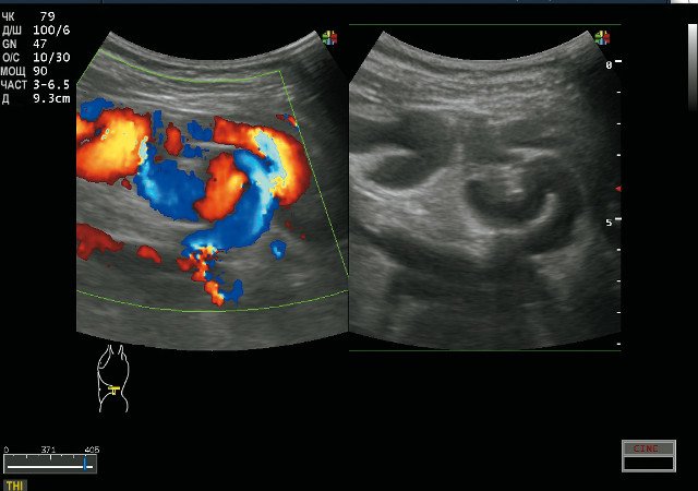 Множественные извитые трубчатые структуры вокруг селезенки: В-режим, ЦДК