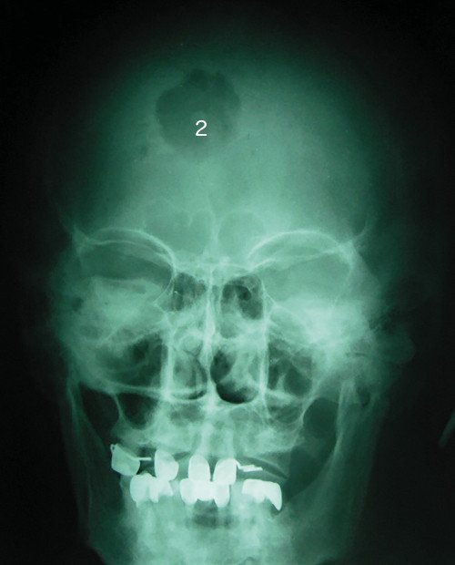 Участок деструкции (2) костей черепа