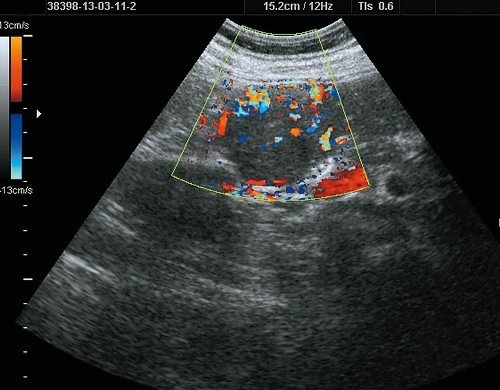 Ультразвуковая картина ФНГ печени: в режиме ЦДК выраженный кровоток в виде баскетбольной корзинки, определяется питающая артерия