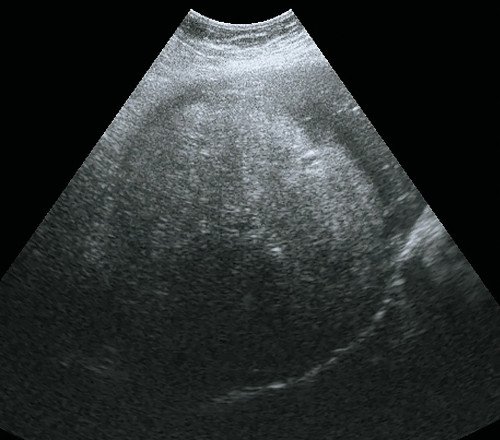 Ультразвуковая картина аденомы печени: В-режим, объемное образование VI-VII сегмента правой доли печени, гетерогенное, преимущественно повышенной эхогенности, с мелкими гипоэхогенными зонами, с ровными четкими контурами, гипоэхогенным ободком