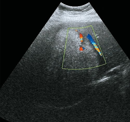 Ультразвуковая картина аденомы печени: режим ЦДК, образование малососудистое, с отсутствием внутреннего кровотока