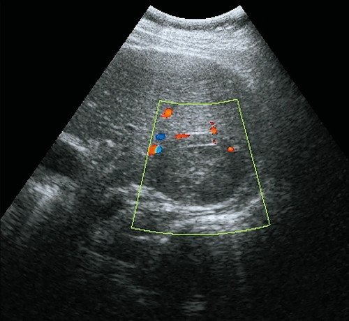 Ультразвуковая картина метастаза печени: режим ЦДК, образование аваскулярное