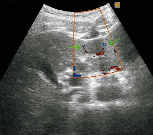 Ультразвуковая картина ФНГ печени у пациентки Г: режим ЦДК, определяется питающая артерия