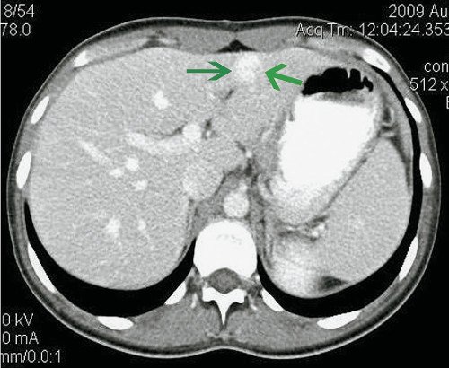 Компьютерные томограммы ФНГ печени у пациентки Г: артериальная фаза, при внутривенном контрастировании в артериальную фазу диффузно интенсивно в виде вспышки накапливает контрастное вещество