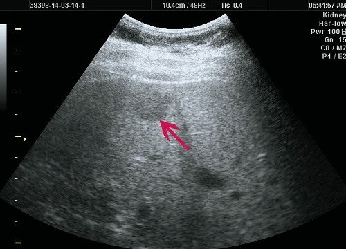 Ультразвуковая картина ФНГ печени у пациентки Р: В-режим, в правой доле печени визуализируется гипоэхогенное образование до 20 мм, с четкими ровными контурами