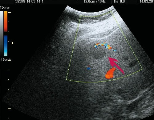 Ультразвуковая картина ФНГ печени у пациентки Р: режим ЦДК, определяется питающая артерия
