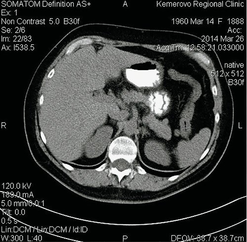 Компьютерная томограмма ФНГ печени у пациентки Р: нативная фаза