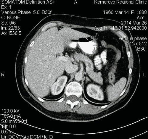 Компьютерная томограмма ФНГ печени у пациентки Р: выделительная фаза