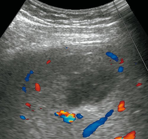 УЗИ печени (режим ЦДК): описываемое образование аваскулярное, по его периферии - деформация сосудистого рисунка